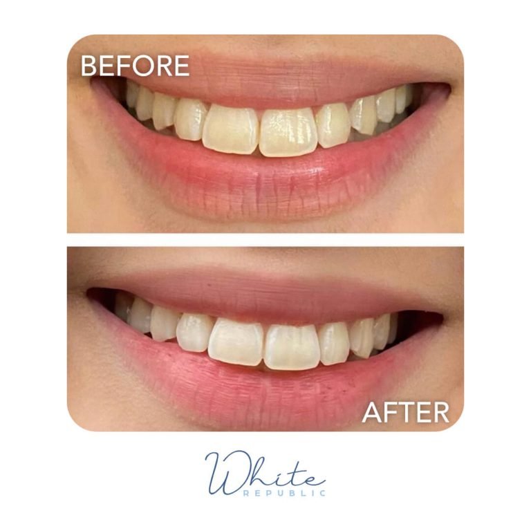 whiterepBeforeAfter