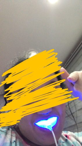 The Original Teeth Whitening Kit photo review