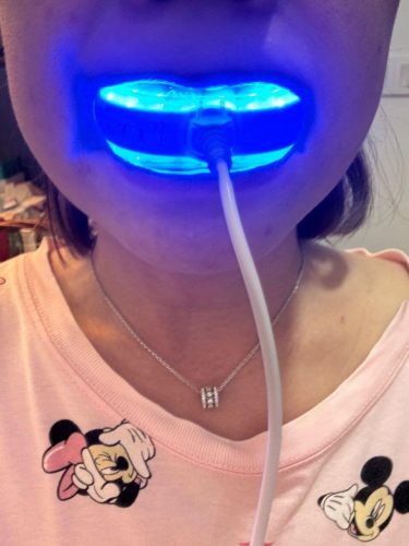 The Original Teeth Whitening Kit photo review