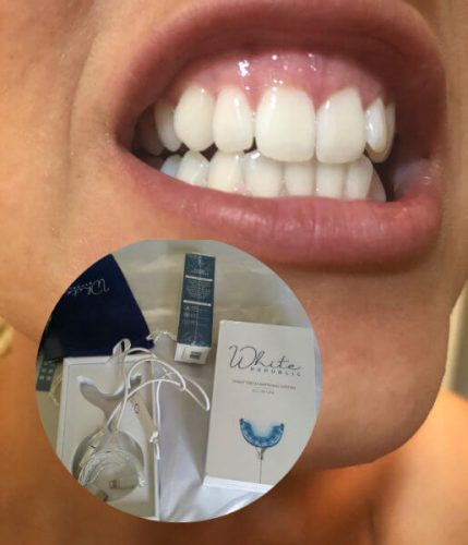 The Original Teeth Whitening Kit photo review
